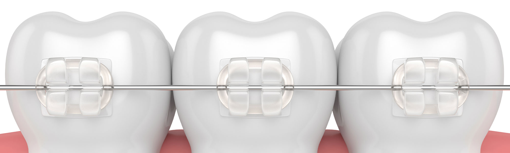 Porcelain Ceramic Braces