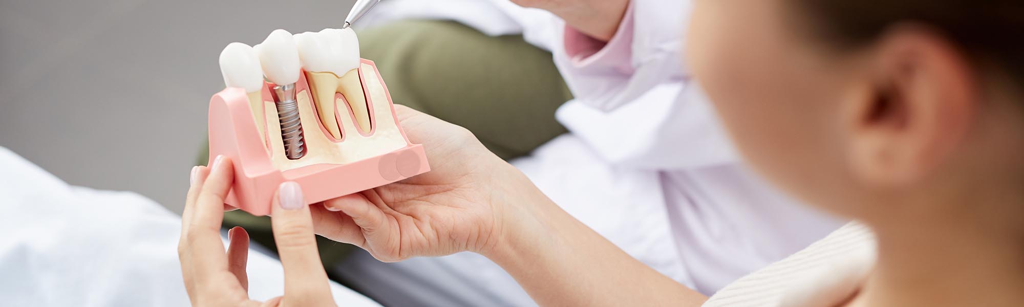  What Are the Different Types of Dental Implants?
