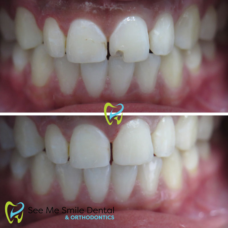 Dental Bonding Santa Barbara