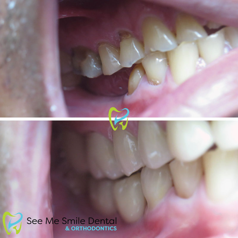 Implants and Veneers Santa Barbara CA
