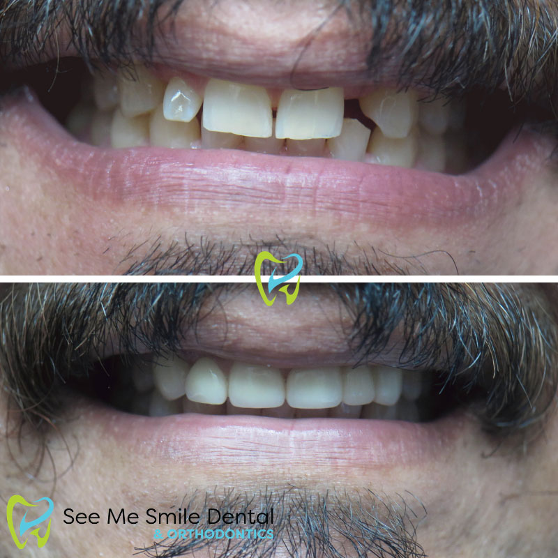 Dental Crowns Santa Barbara CA