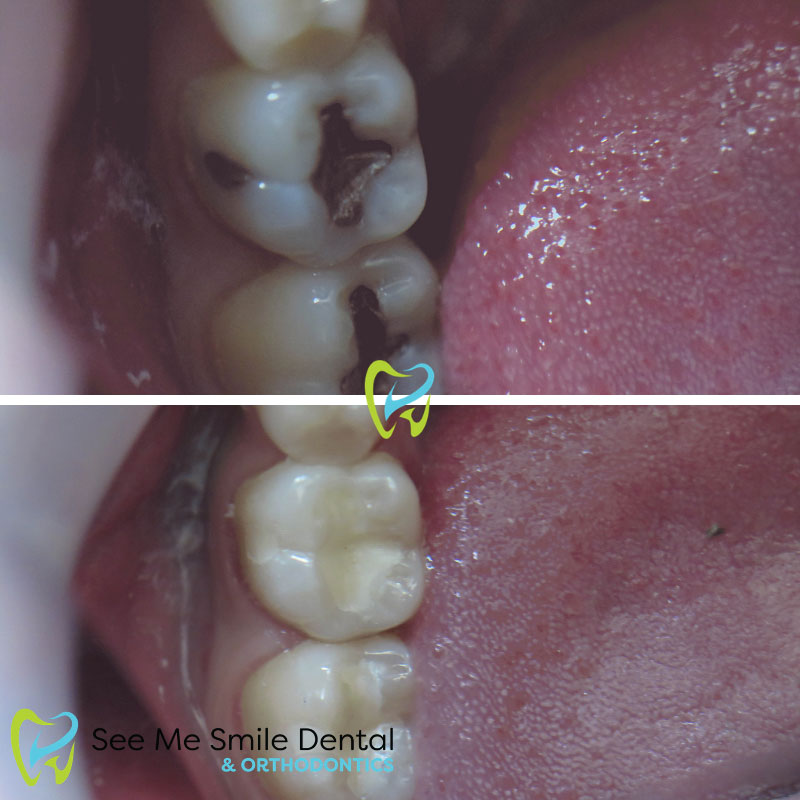 Dental Fillings Santa Barbara