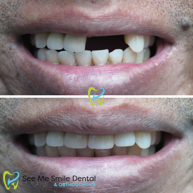 Dental Implants Santa Barbara 
