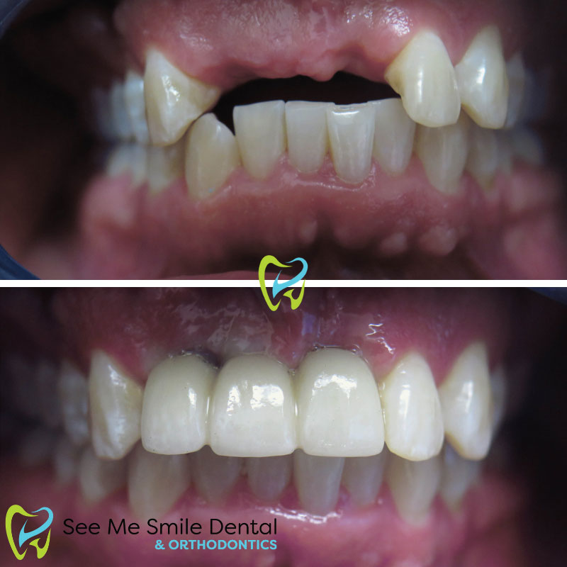 Implants and Dental Crowns Santa Barbara CA