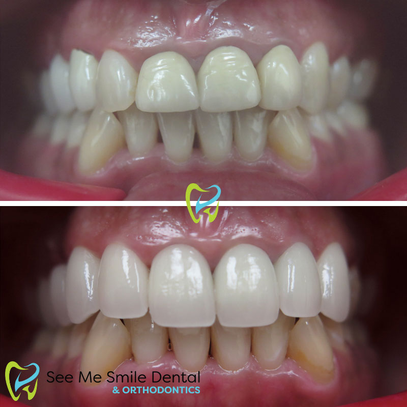Veneers in Santa Barbara CA
