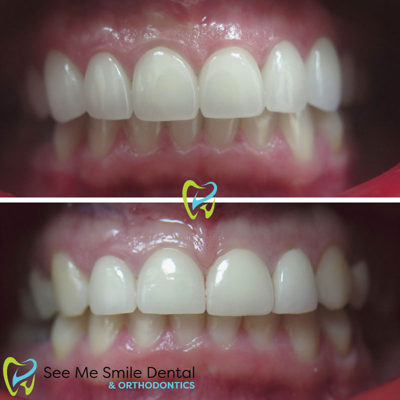 Veneers in Santa Barbara