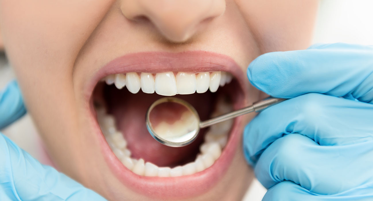 Composite Filling Dentist Santa Barbara
