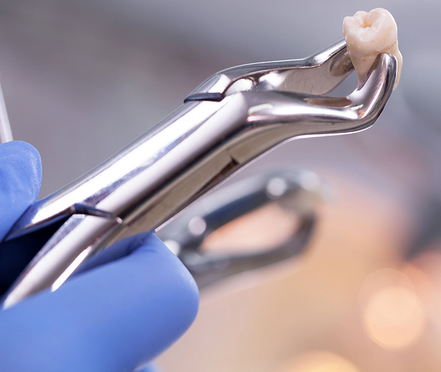 Surgical Tooth Extraction Santa Barbra CA
